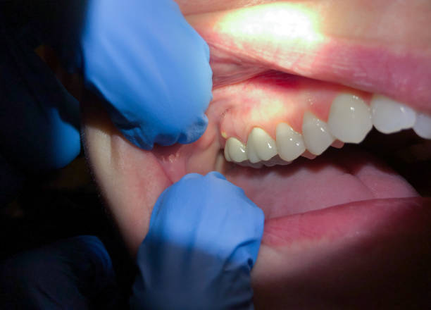 Best Emergency Dental Care for Abscessed Tooth in Manhattan, NY